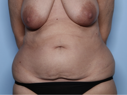 Tummy Tuck Before & After Patient #34291